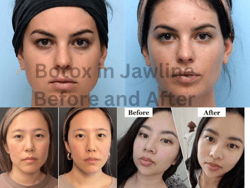 The Transformative Journey: Botox in Jawline Before and After | Healthy ...